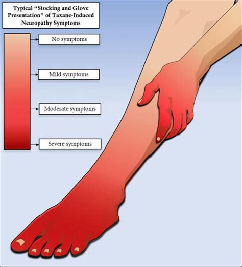 stocking glove syndrome|Peripheral Neuropathy: Evaluation and Differential Diagnosis